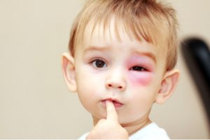 common allergies in kids